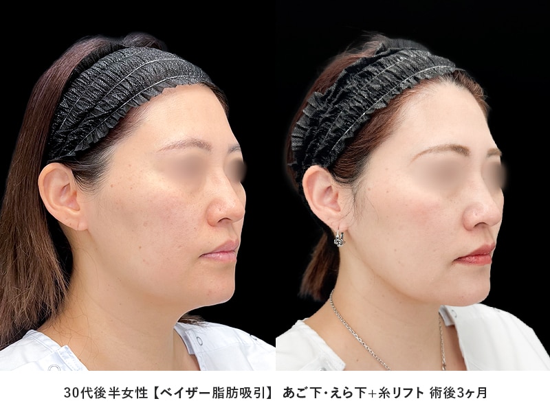 顔の脂肪吸引症例3