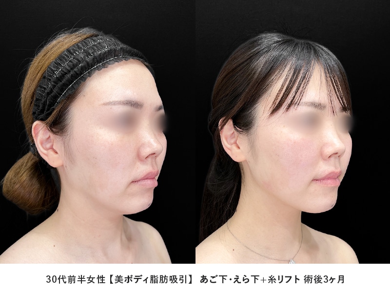 顔の脂肪吸引症例4