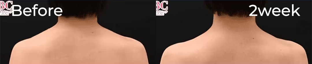 肩ボトックス(アラガン製)症例写真