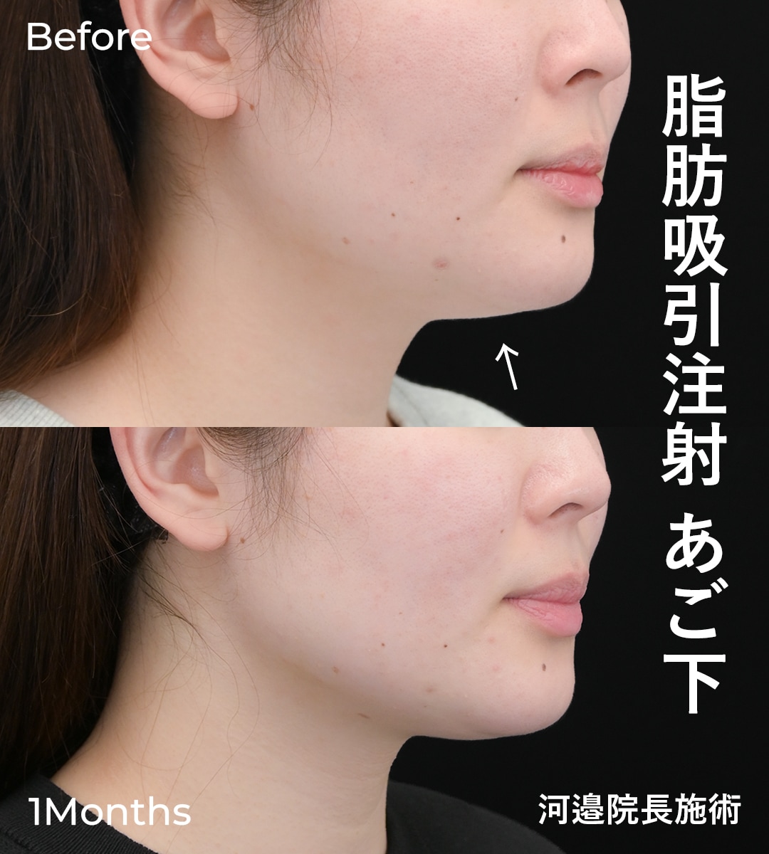 脂肪吸引注射症例写真
