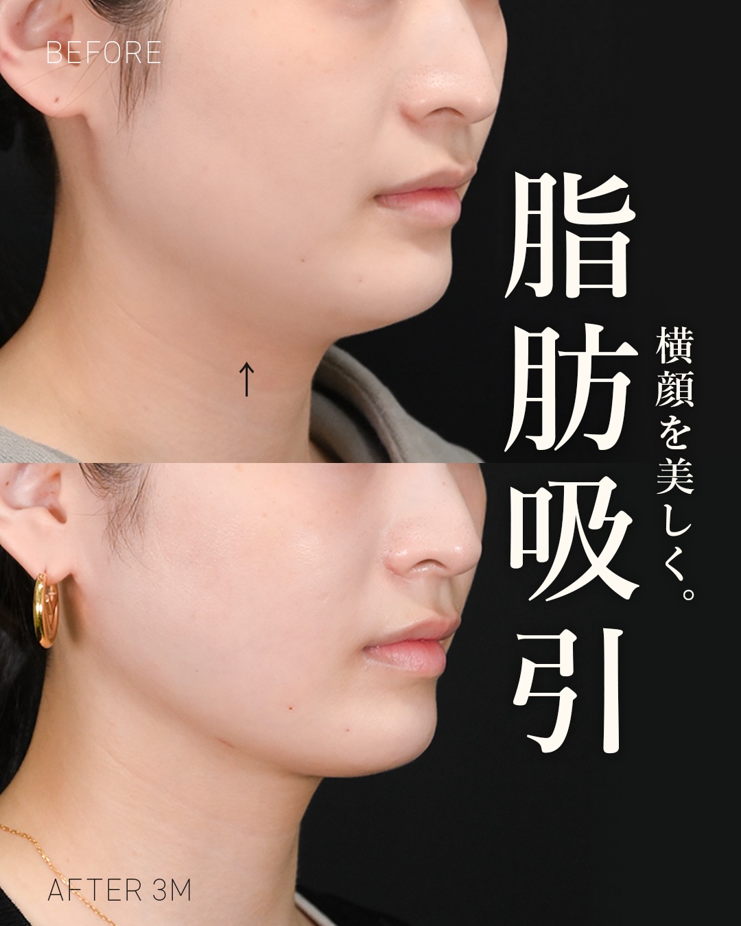 顔の脂肪吸引 症例写真1