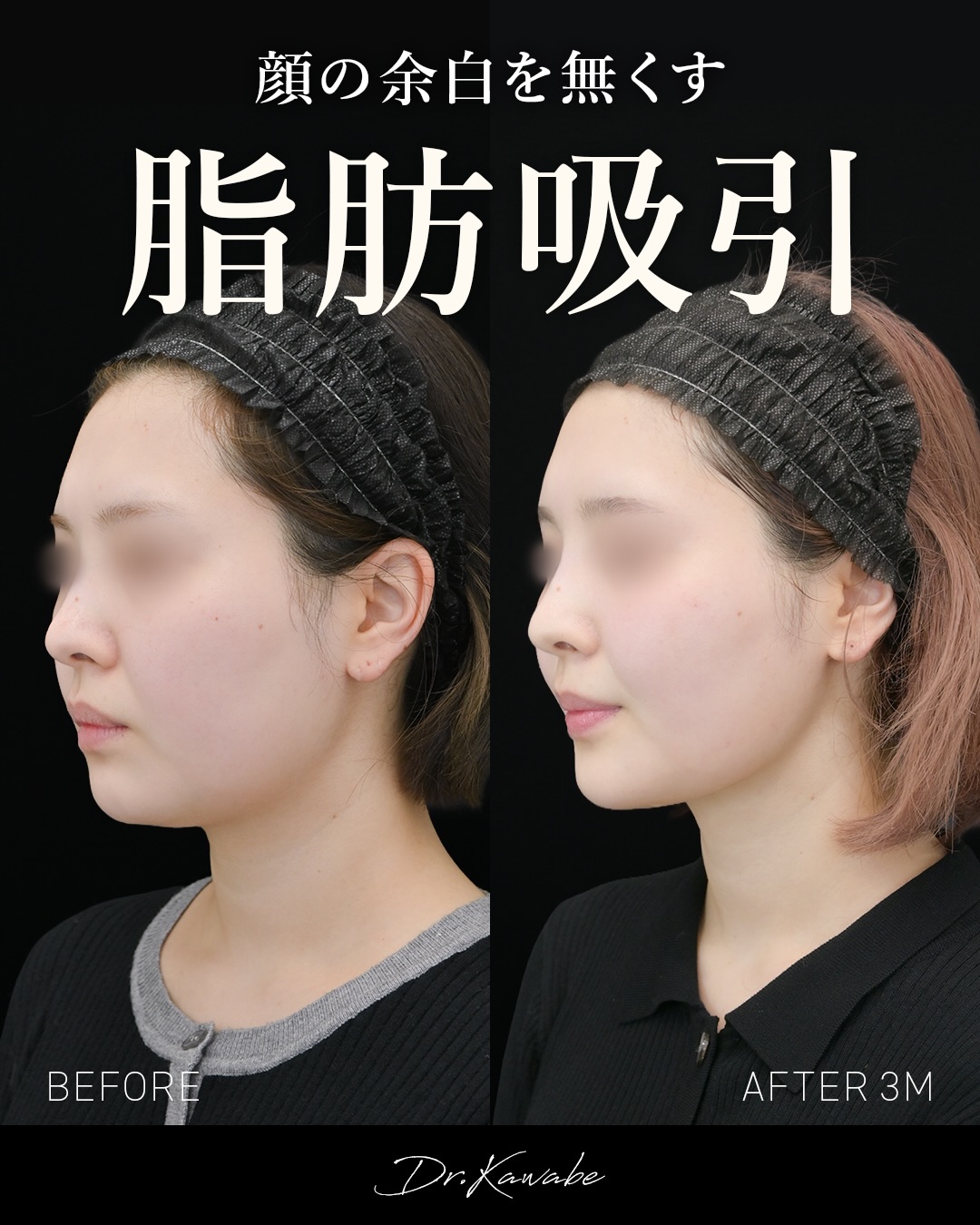 顔の脂肪吸引 症例写真2