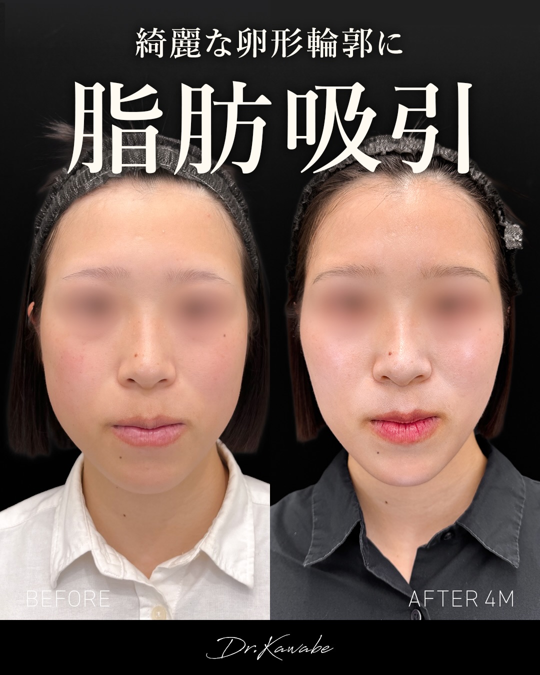 顔の脂肪吸引 症例写真3