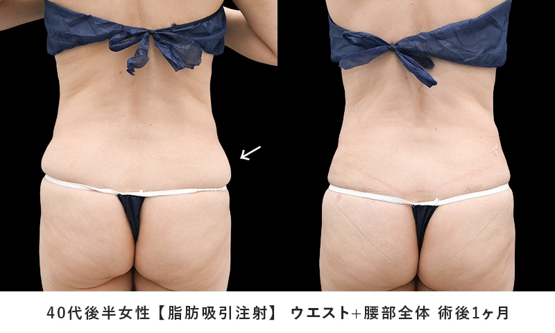小顔用脂肪吸引注射 症例写真