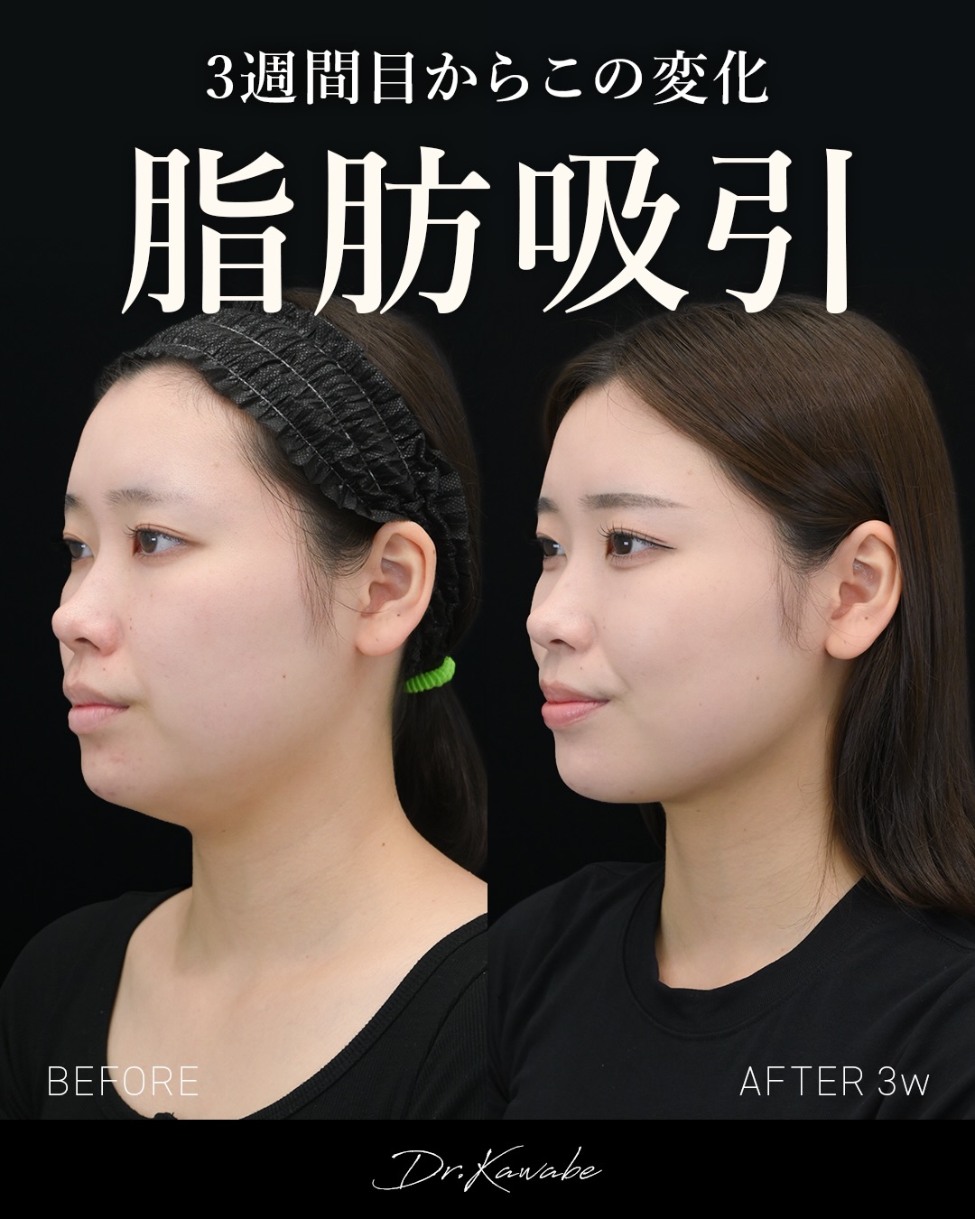 顔の脂肪吸引 症例写真4