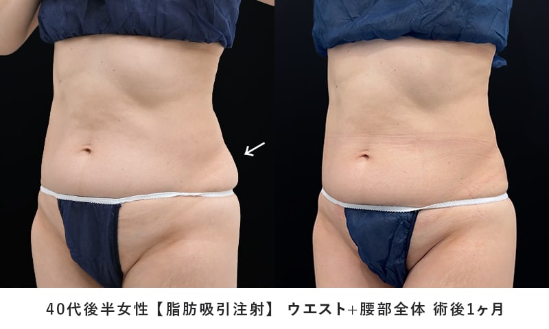 小顔用脂肪吸引注射 症例写真