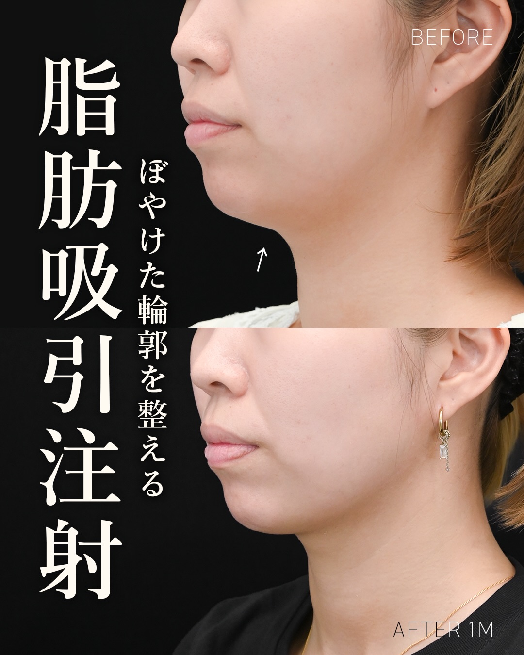 河邉医師脂肪吸引症例写真5