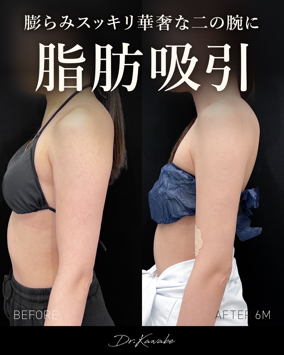 河邉医師脂肪吸引症例写真7