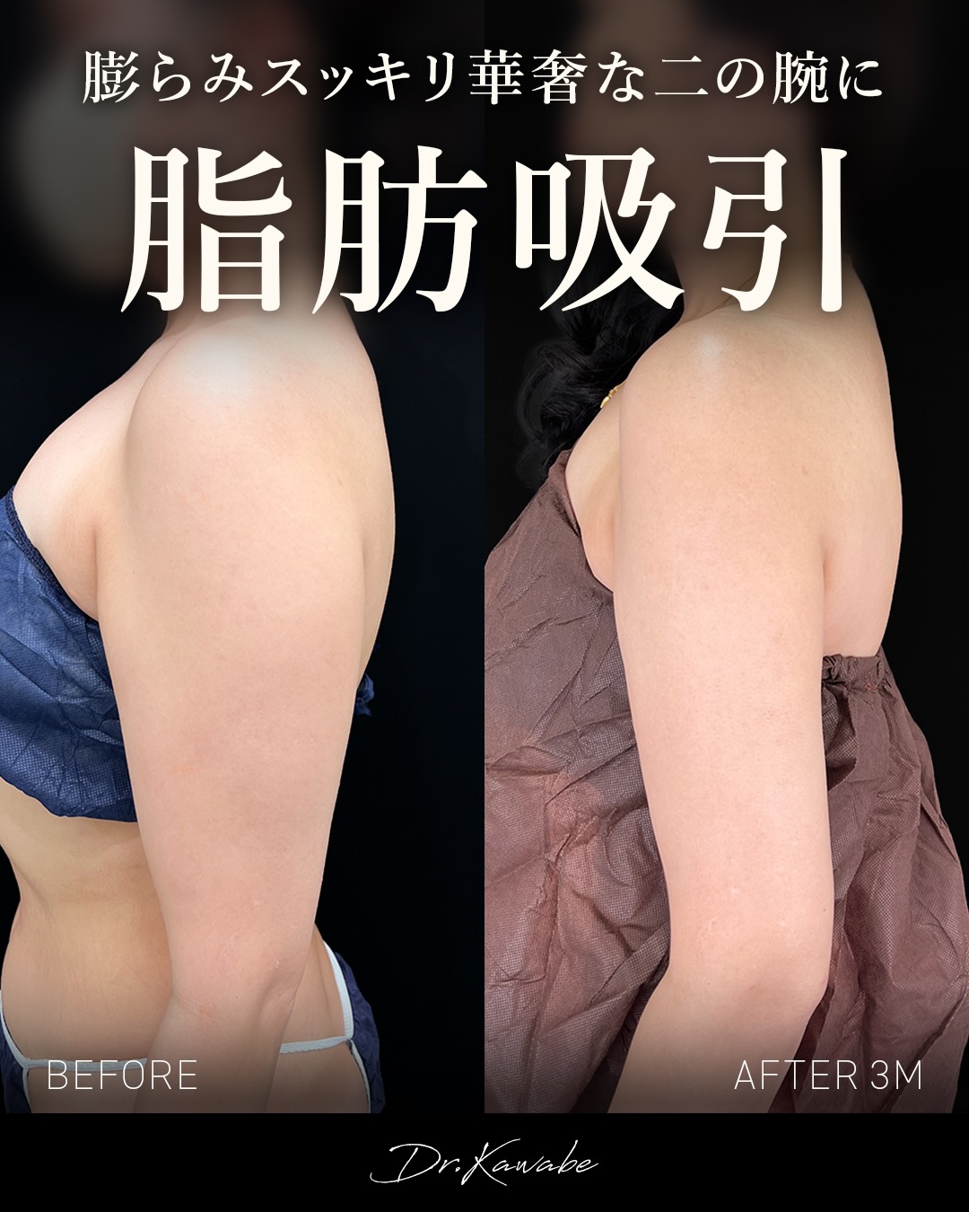 河邉医師脂肪吸引症例写真8