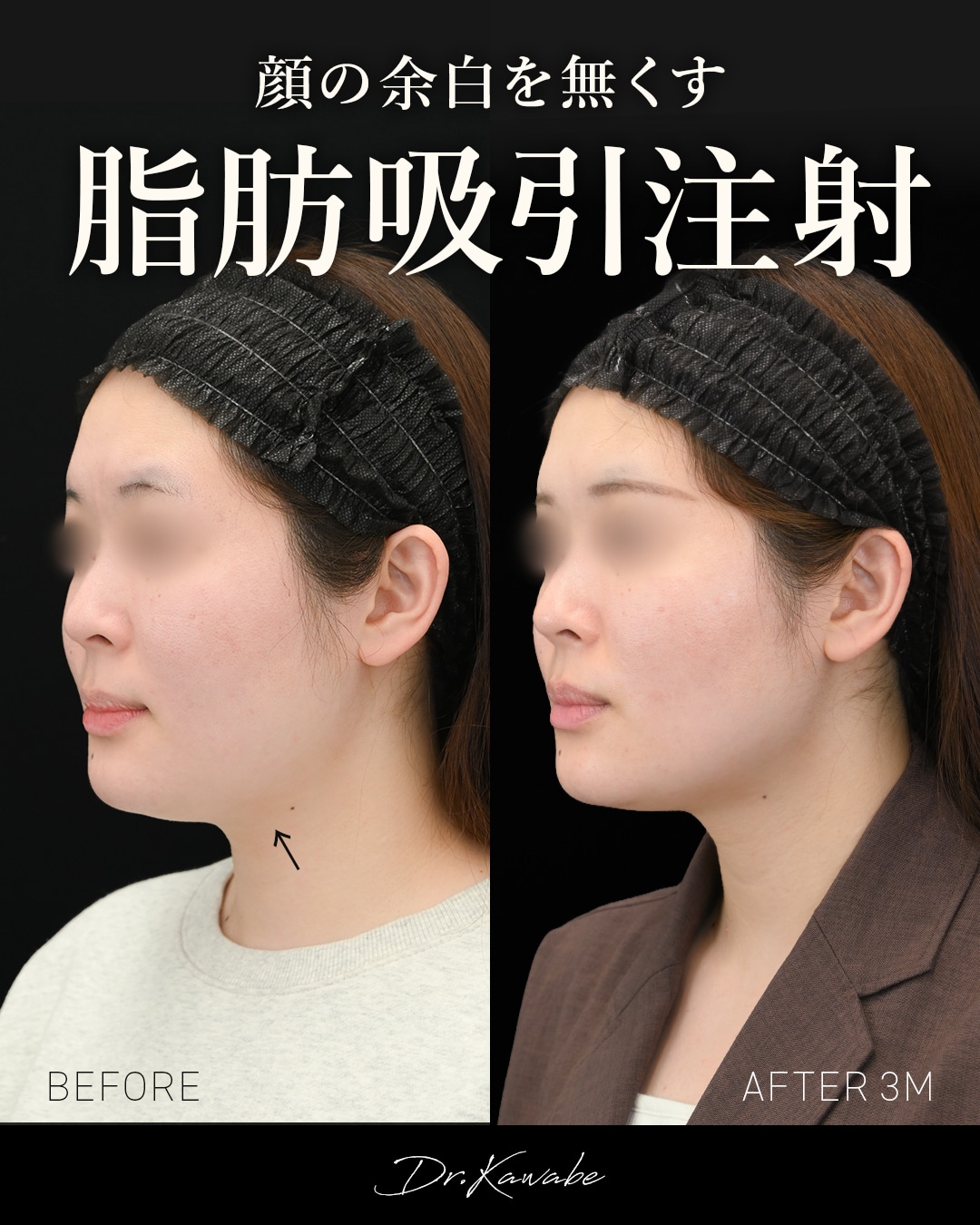 顔の脂肪吸引 症例写真5