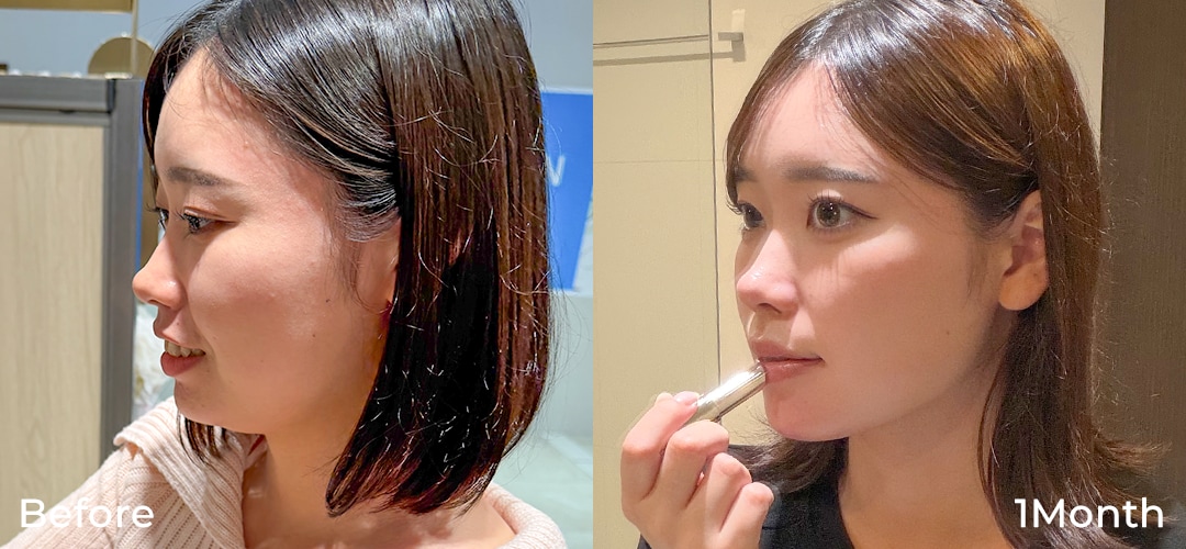 顔の脂肪吸引症例写真