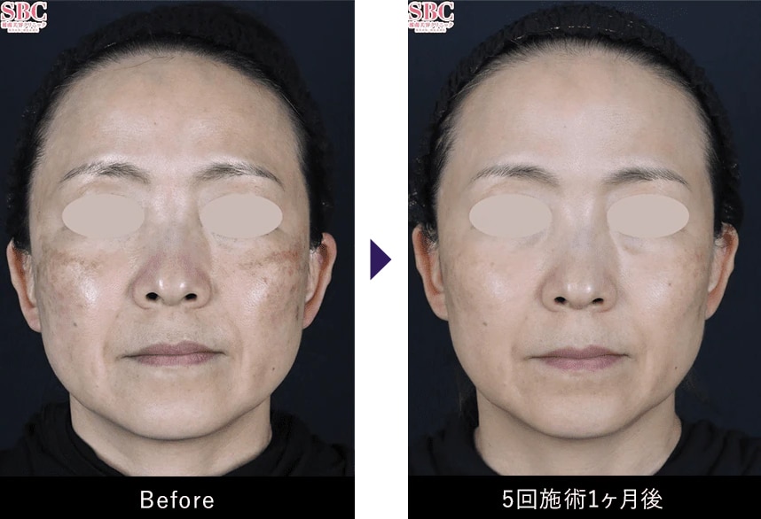 シルファームX 症例写真(Before / After)