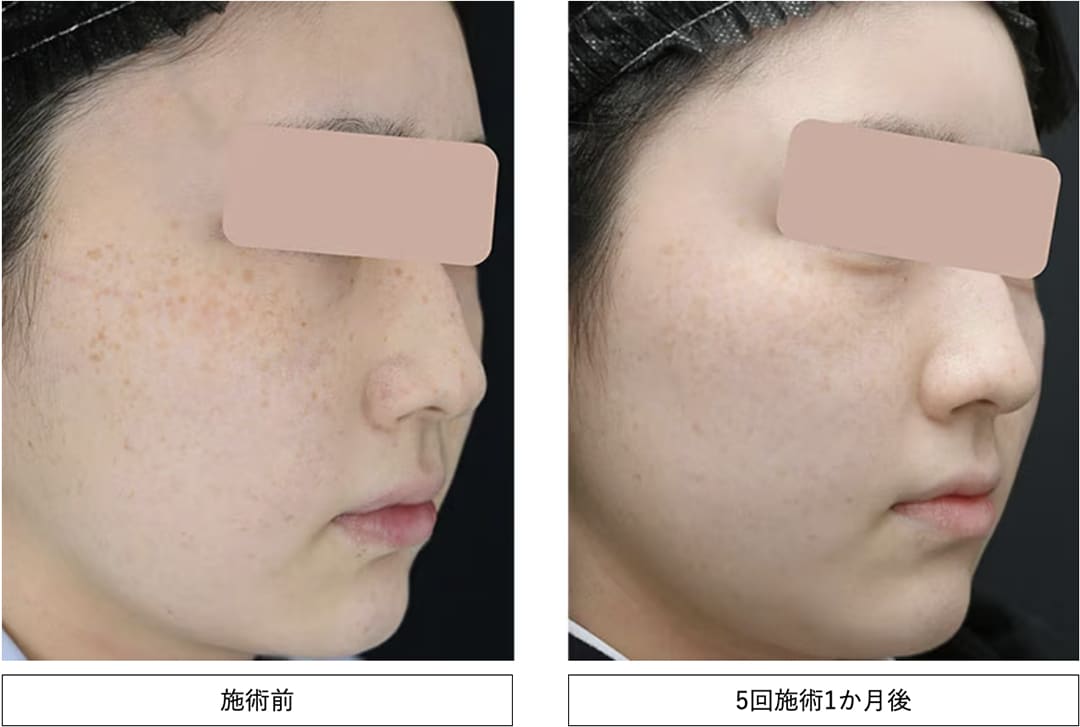 IPL光治療（フォトダブル(R)・フォトトリプル）症例写真
