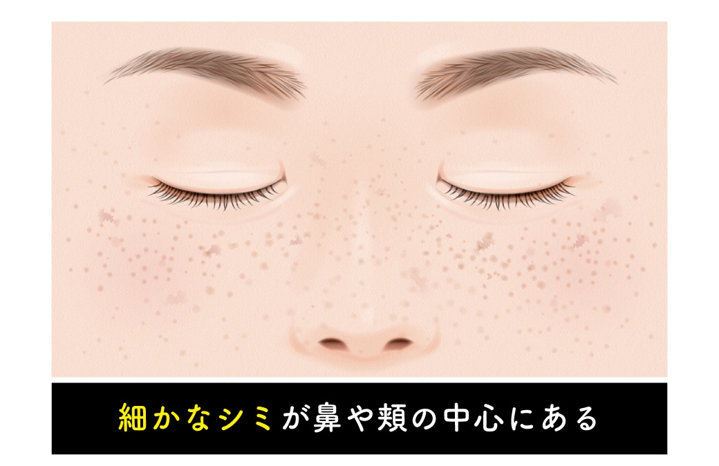 そばかす