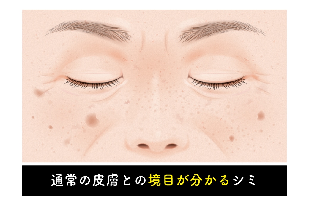 老人性色素斑