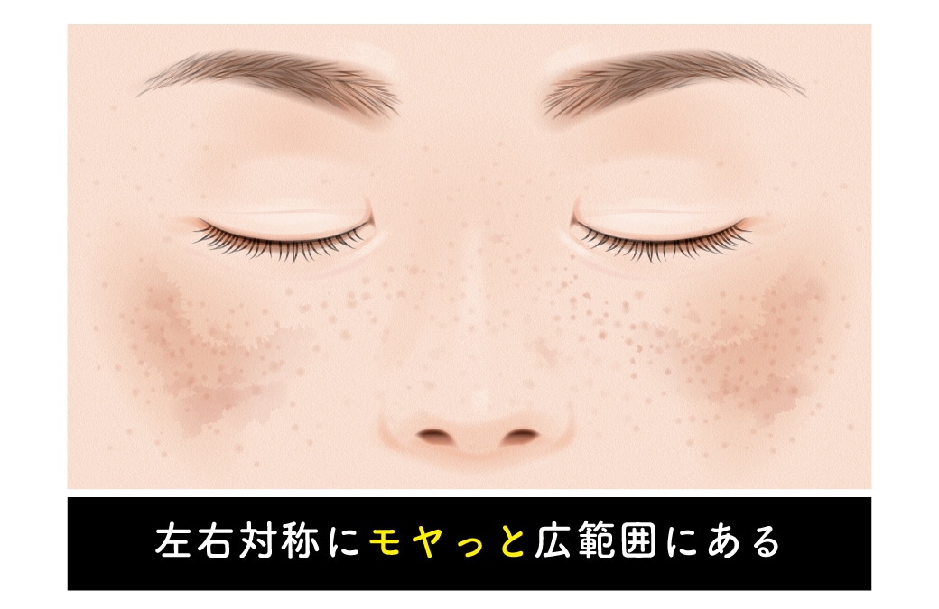肝斑(かんぱん)