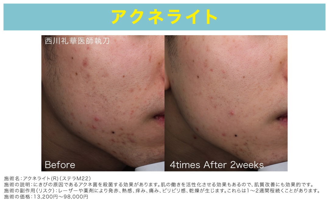 光エネルギーで<br />
ニキビの原因となるアクネ菌を殺菌！