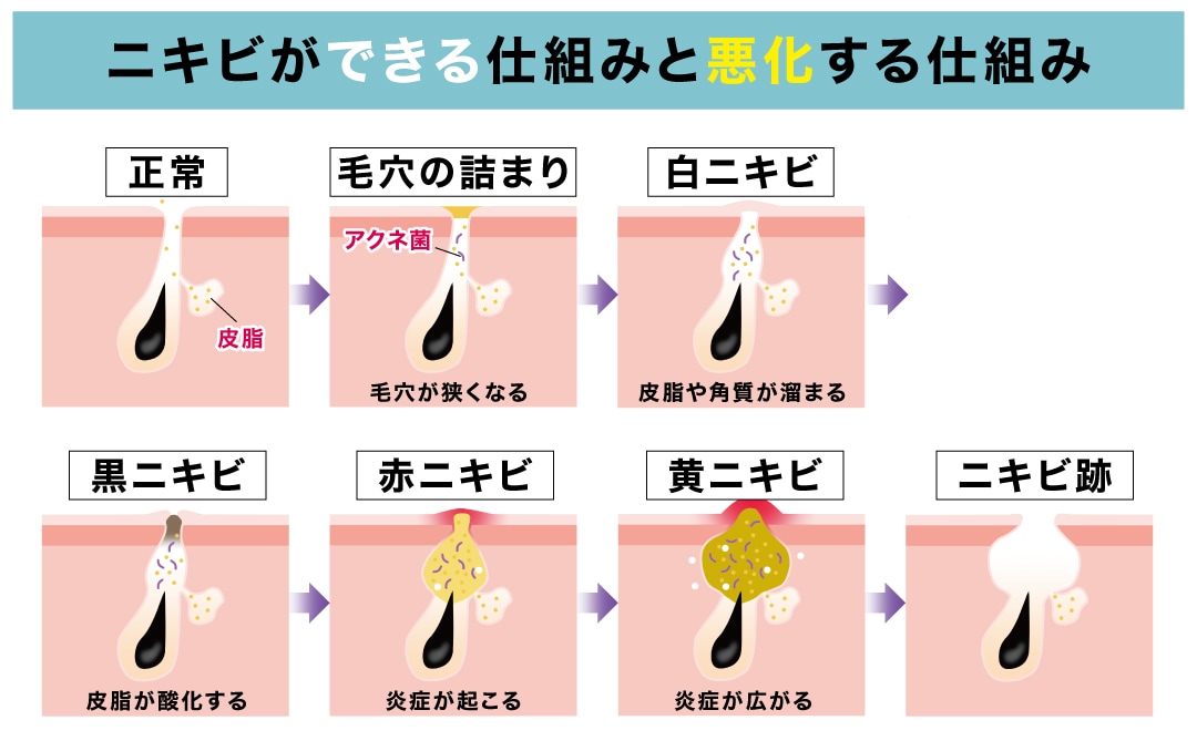 ニキビが「できる仕組み」と「悪化する仕組み」