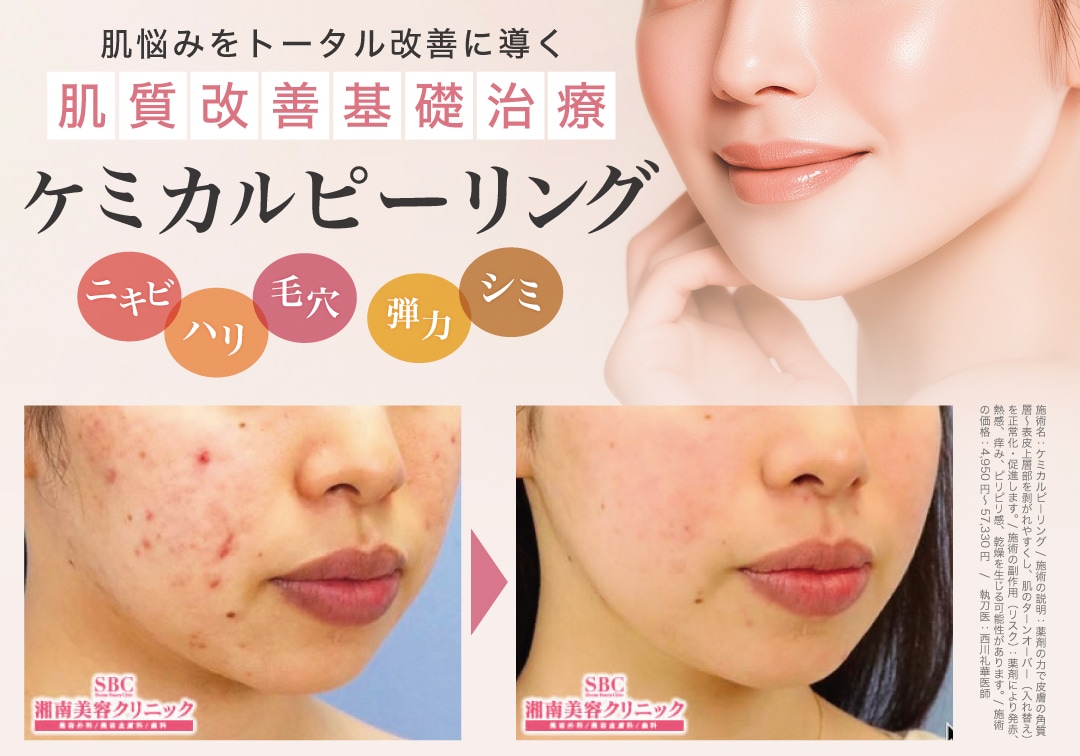 ケミカルピーリング
