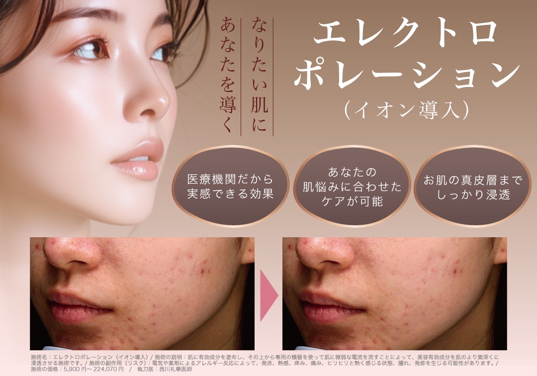 エレクトロポレーション