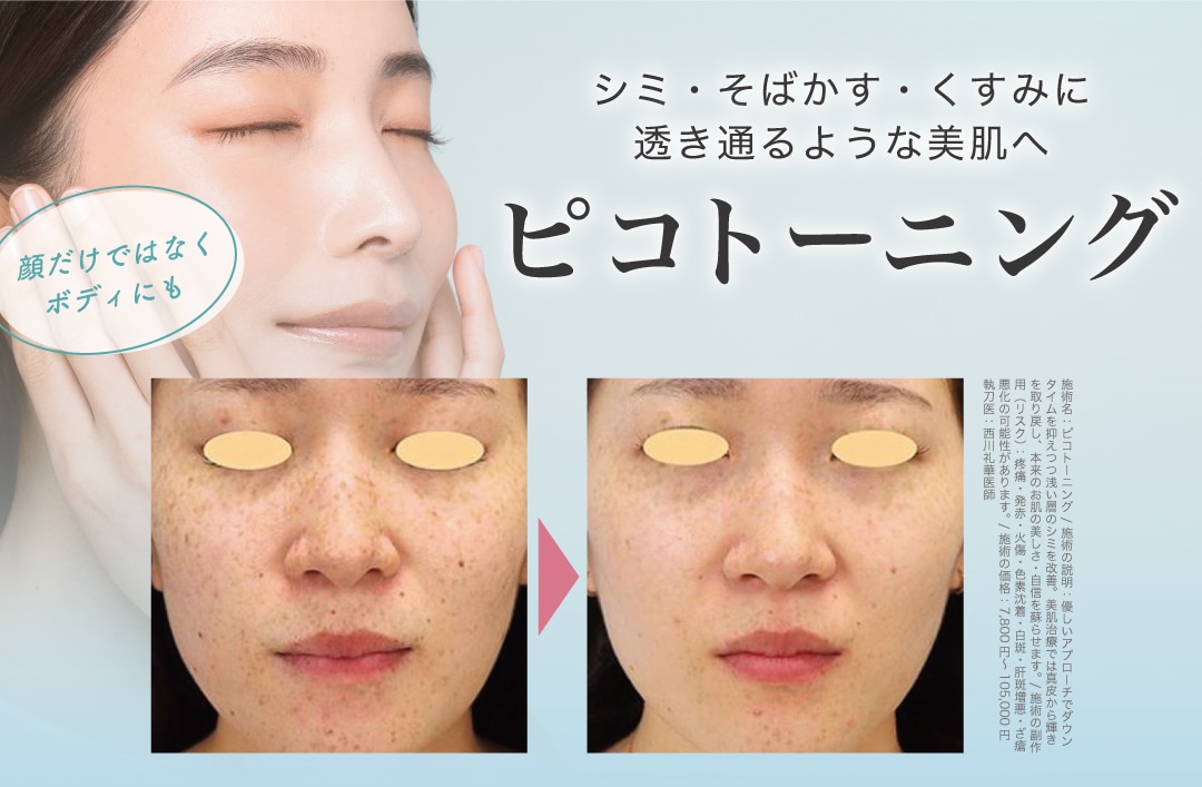 ピコトーニング