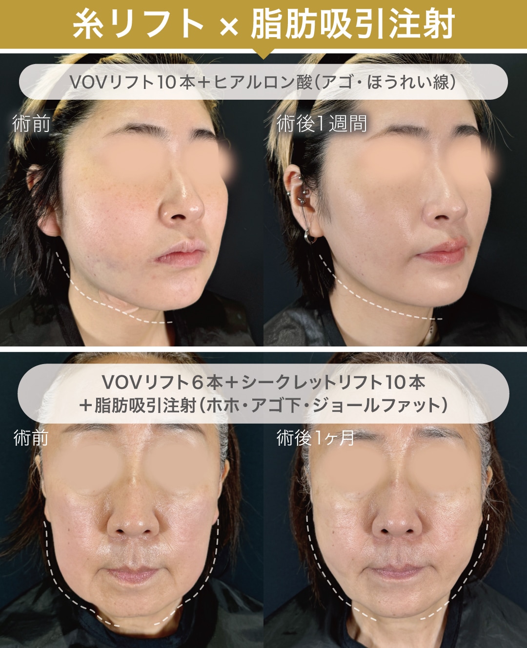 糸リフト×脂肪吸引注射