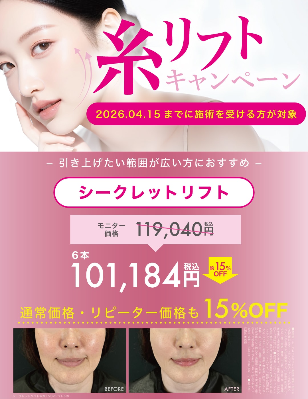 シークレットリフト