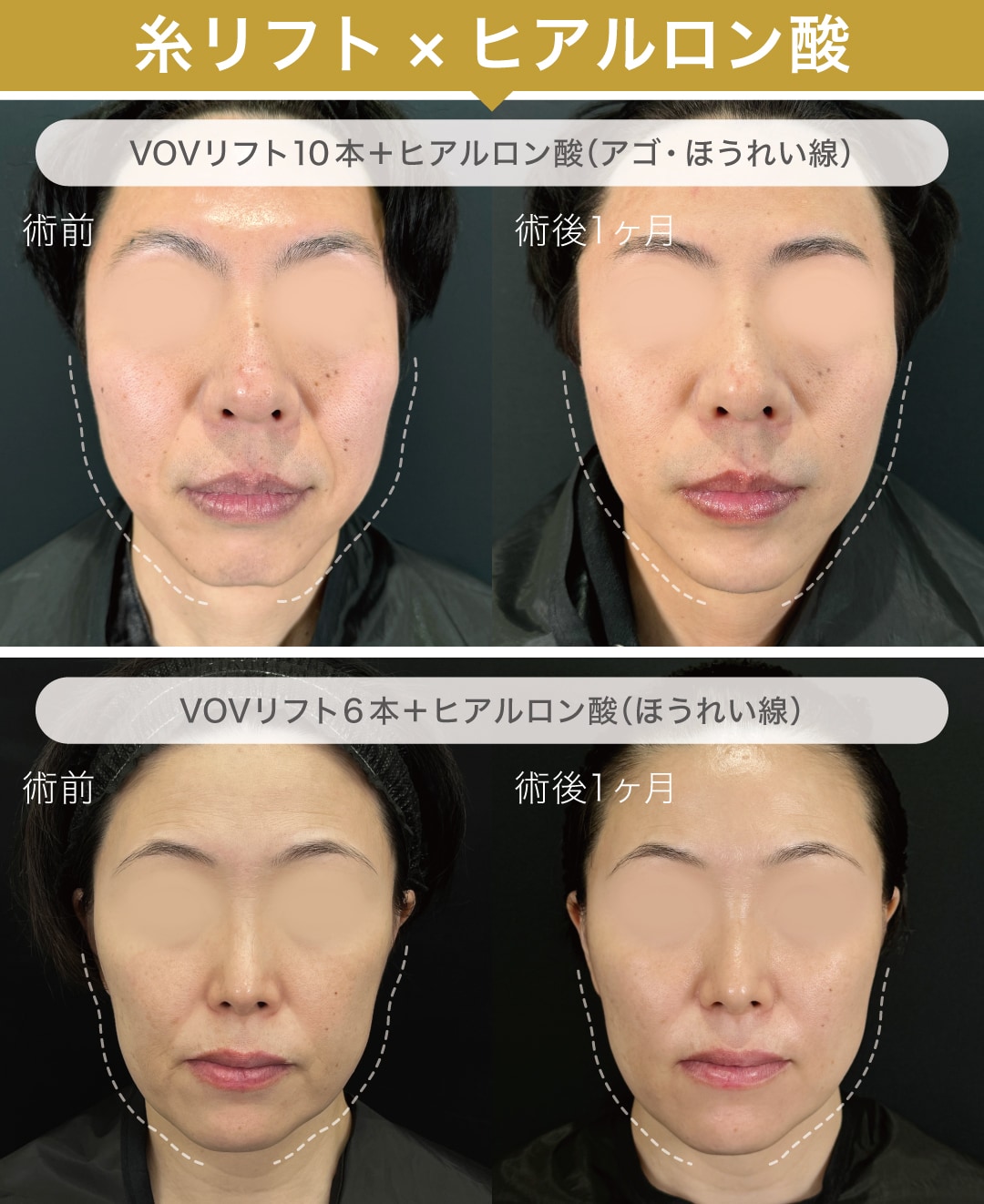 糸リフト×ヒアルロン酸