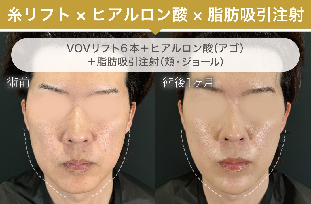 糸リフト×ヒアルロン酸×脂肪吸引注射