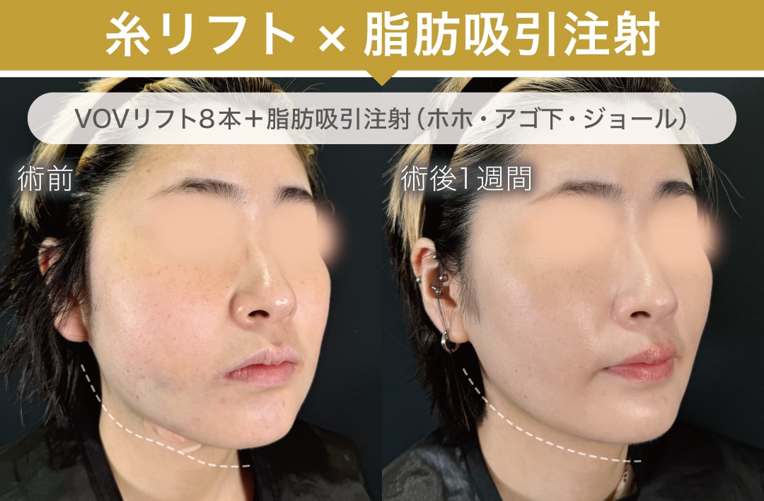 糸リフト×脂肪吸引注射
