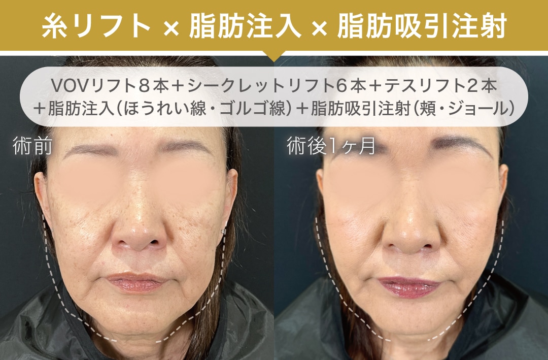 糸リフト×脂肪注入×脂肪吸引注射