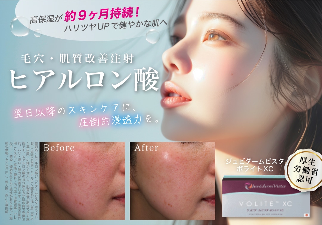 ジュビダームビスタボライトXC