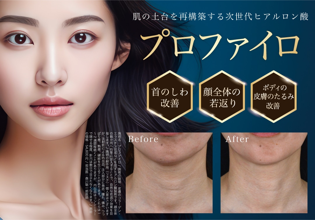 プロファイロ