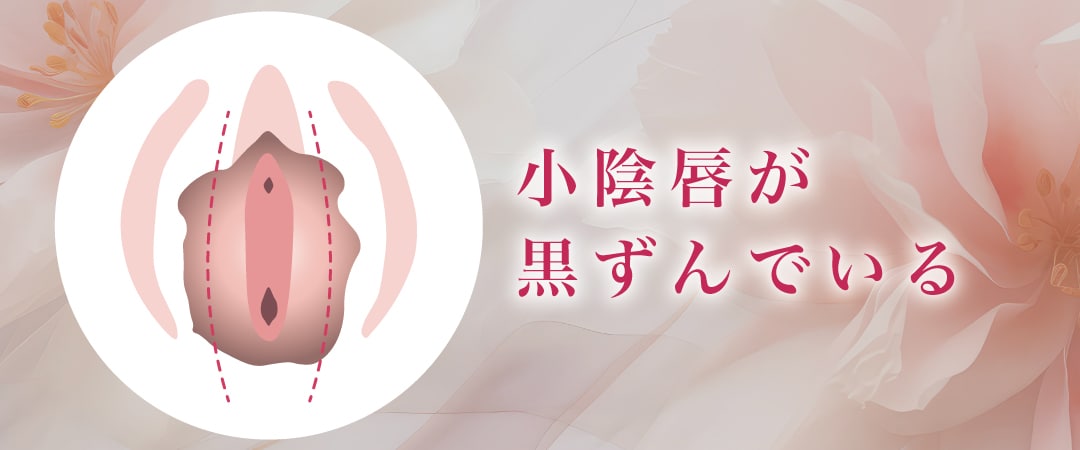 小陰唇が黒ずんでいる