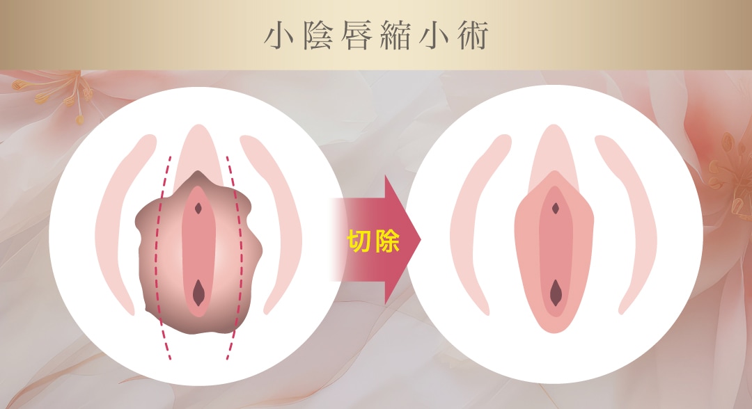 小陰唇縮小術とは