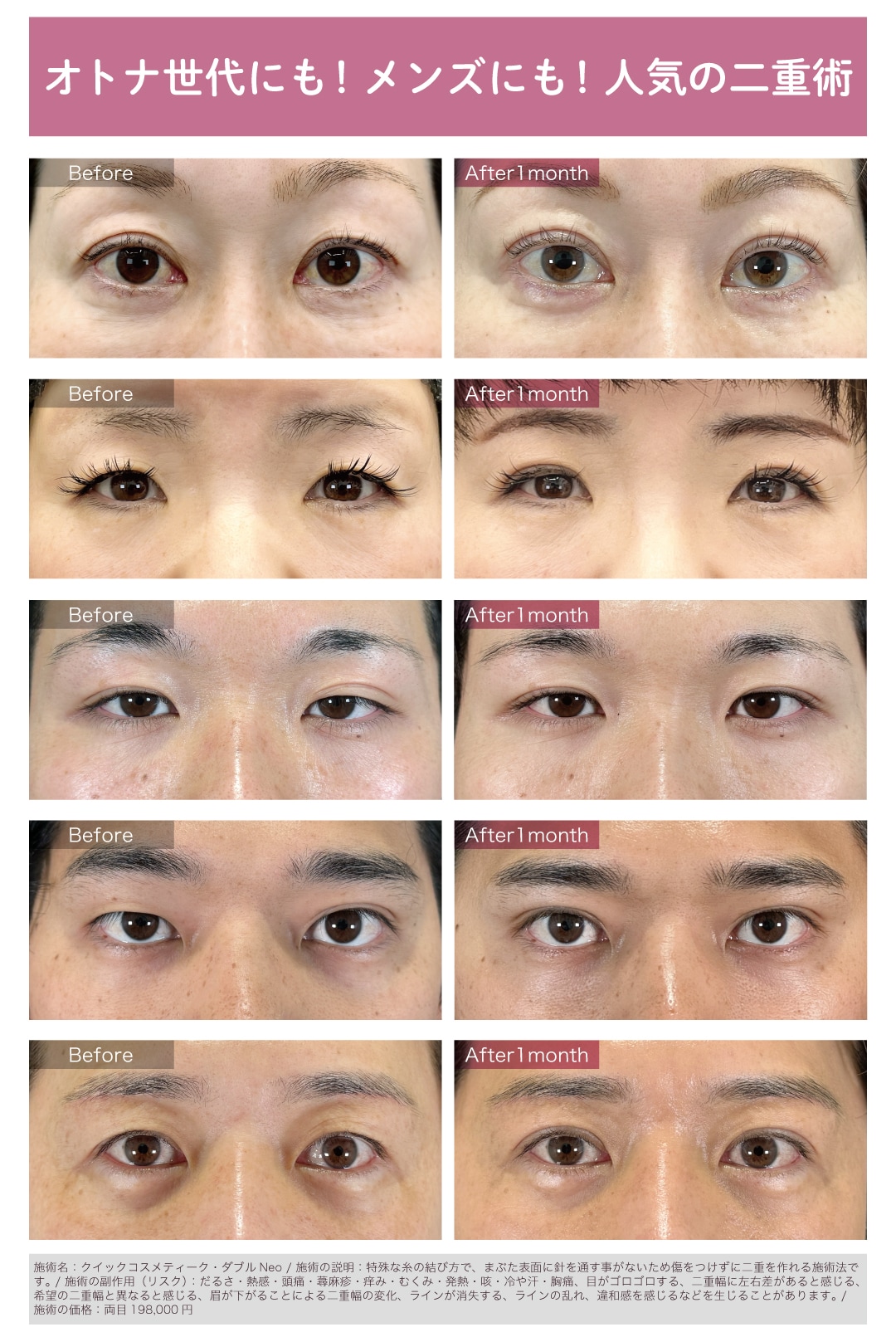 切らないまぶたのリフトアップとしても人気！<br />
メンズも二重にする方増えてます！