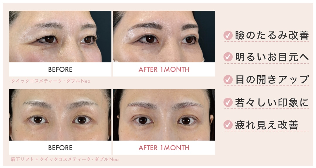 目元の若返り✨