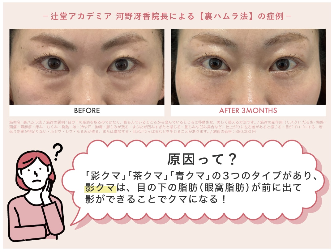 影クマができる原因