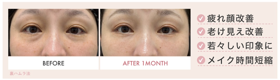 クマ改善で目元の若返り✨