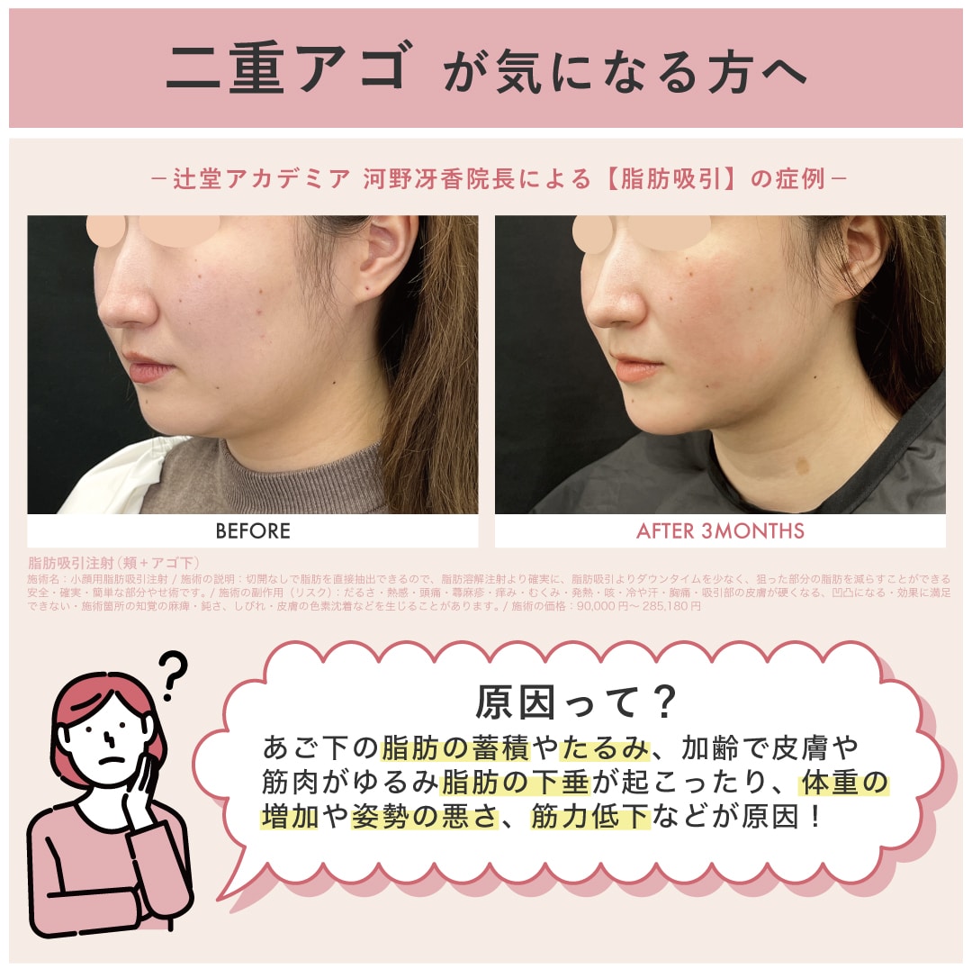 二重アゴの原因