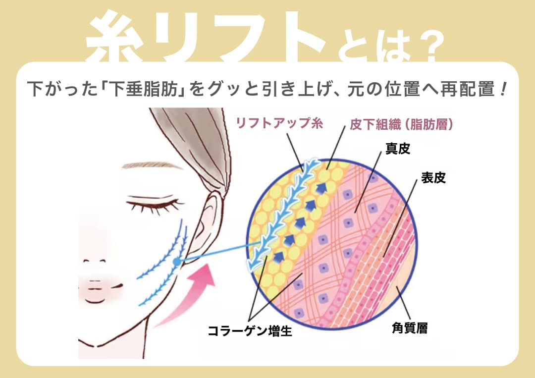 医療用の特殊な糸を皮下に挿入し、たるんだ組織を引き上げる