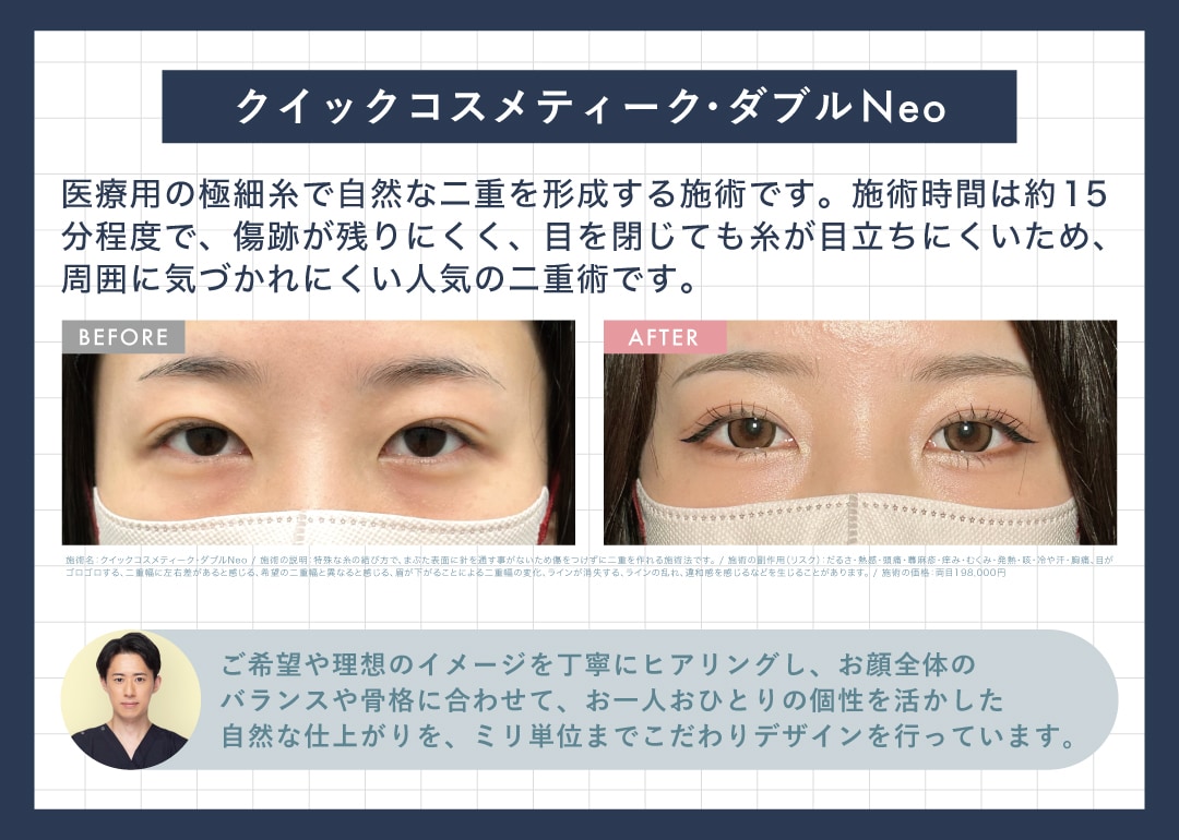 埋没法二重術｜クイックコスメティーク・ダブルNeo