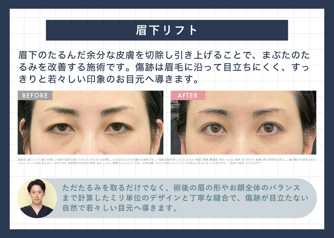 眉下切開｜眉下リフト