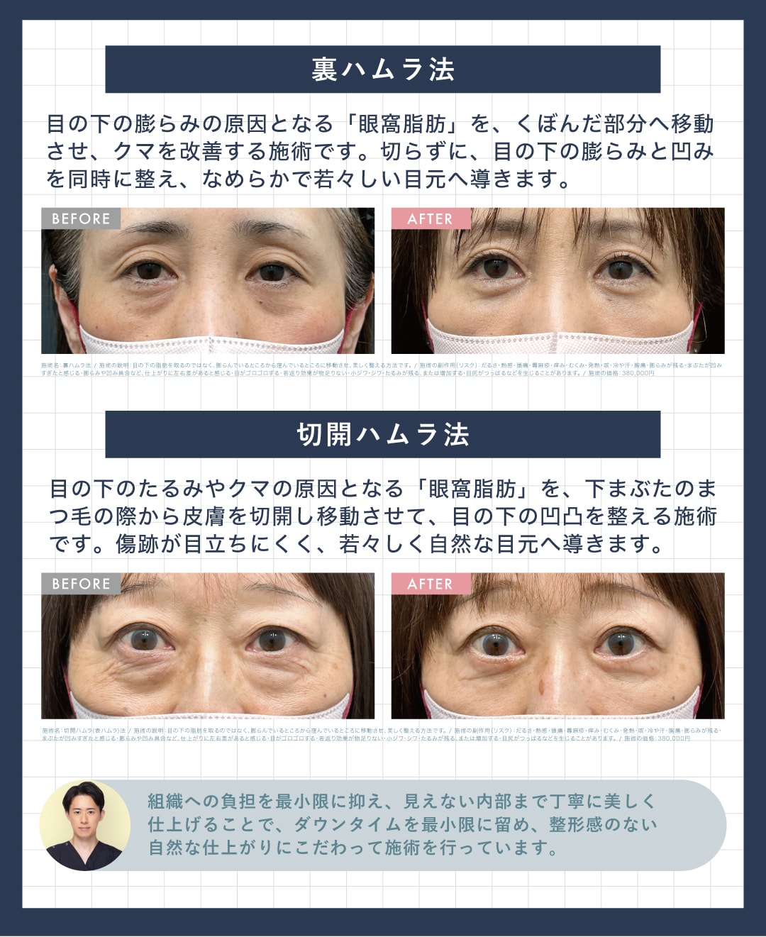 クマ取り｜裏ハムラ法・切開ハムラ法