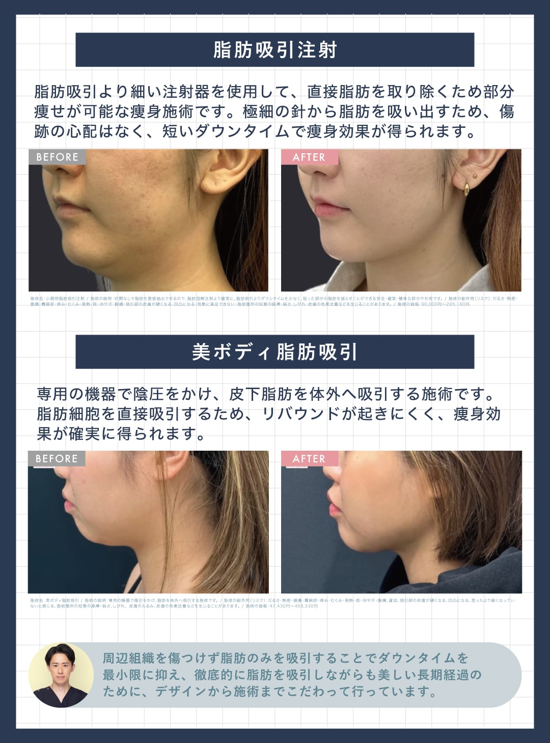 脂肪吸引｜脂肪吸引注射・美ボディ脂肪吸引