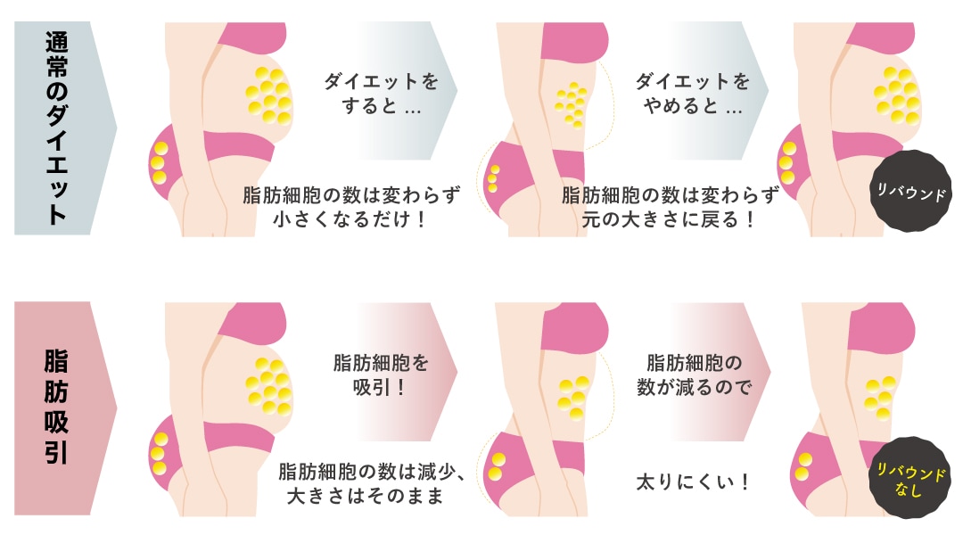 脂肪吸引とダイエットとの違い