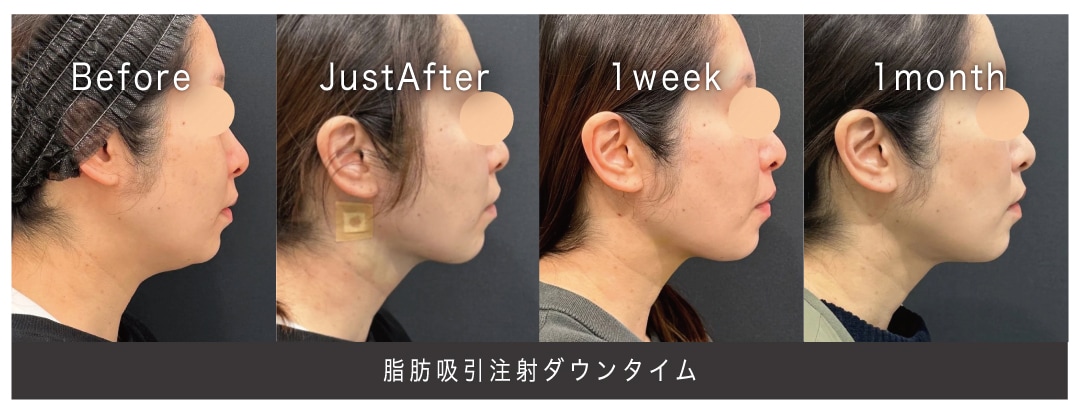 最小限のダウンタイムで、最大限の美しさを