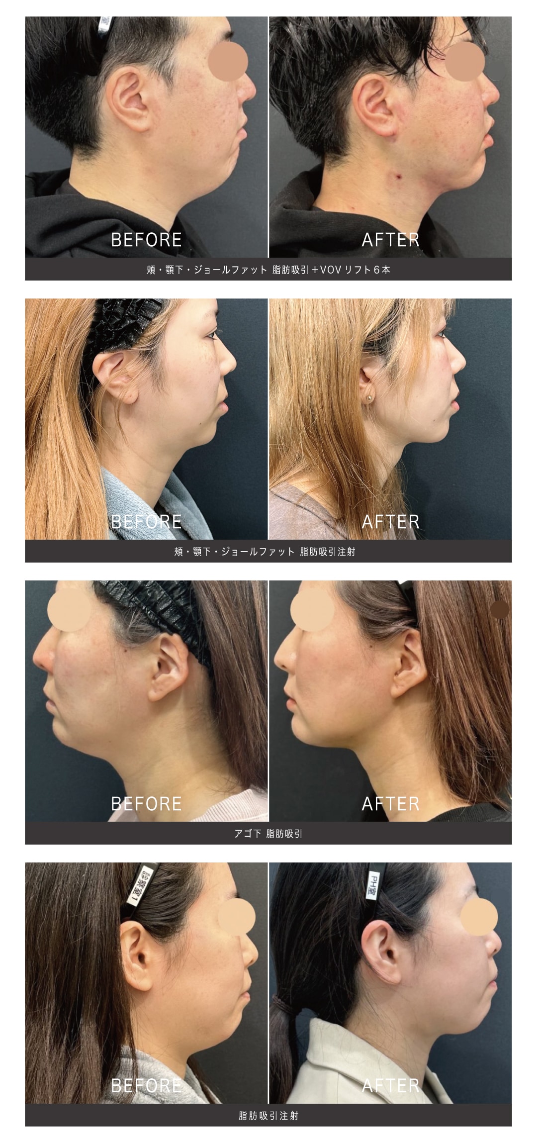 脂肪吸引 / 脂肪吸引注射 の症例