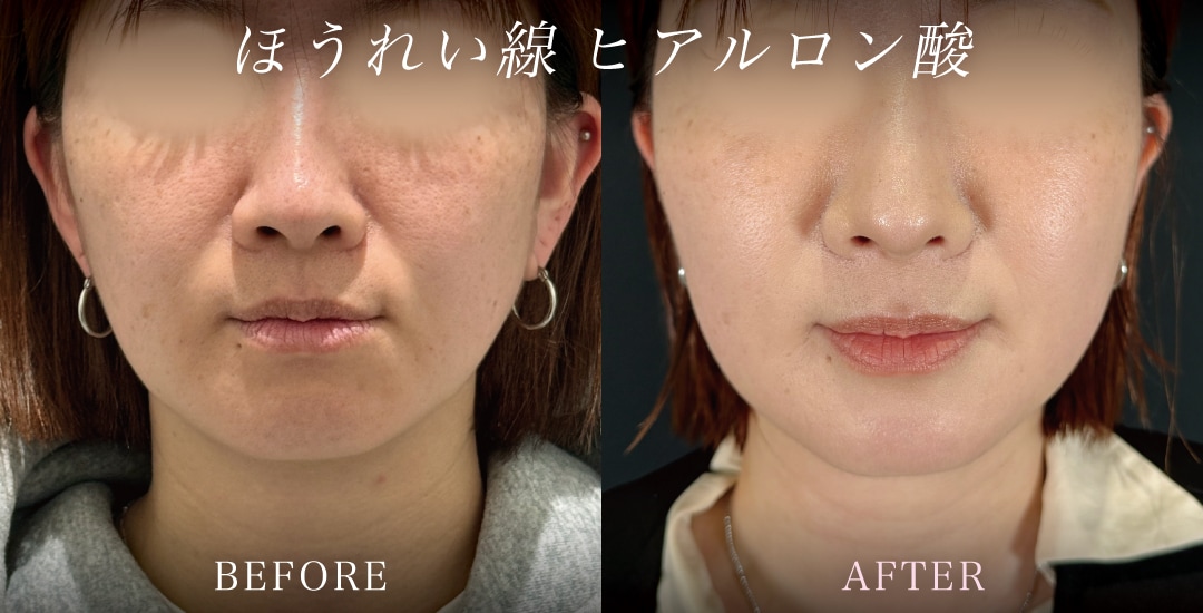 ほうれい線のお悩みを解消し、自然な若々しさへ