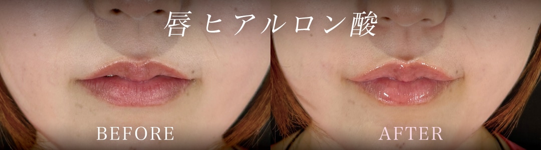唇ヒアルロン酸注入で、口元のバランスを整える